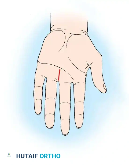 Distal longitudinal palmar incision