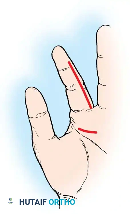 Open drainage for advanced infection and necrosis of tendon and sheath