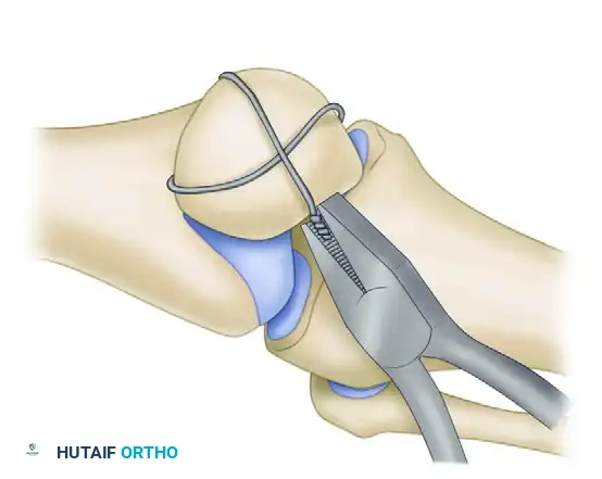 FIGURE 54-63 A-C, Schauwecker method of com pression wiring of patella using supplemental screws for comminuted fracture (C) . Comminuted fragments (A) are transformed with screws into bifragmental fracture (B) . SEE TECHNIQUE 54-21.