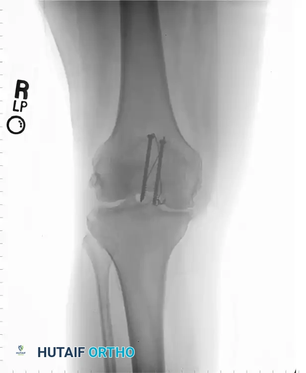 TENSION BAND WIRING FIXATION Surgical Diagram