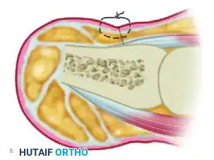 TERMINAL SYME PROCEDURE Surgical Diagram