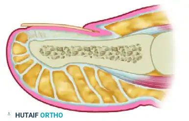 TERMINAL SYME PROCEDURE Surgical Diagram