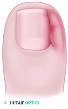 TERMINAL SYME PROCEDURE Surgical Diagram