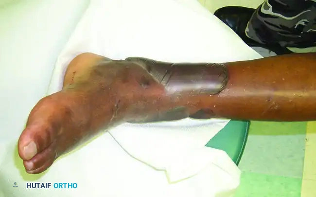 Tetanus Prophylaxis and Soft Tissue Management in Orthopaedic Trauma