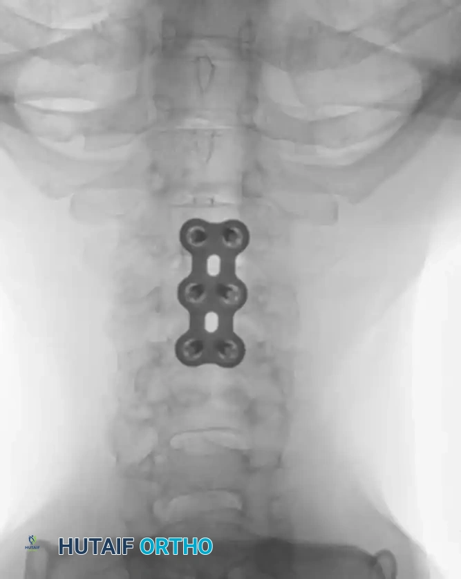 Anterior Plating Diagram B