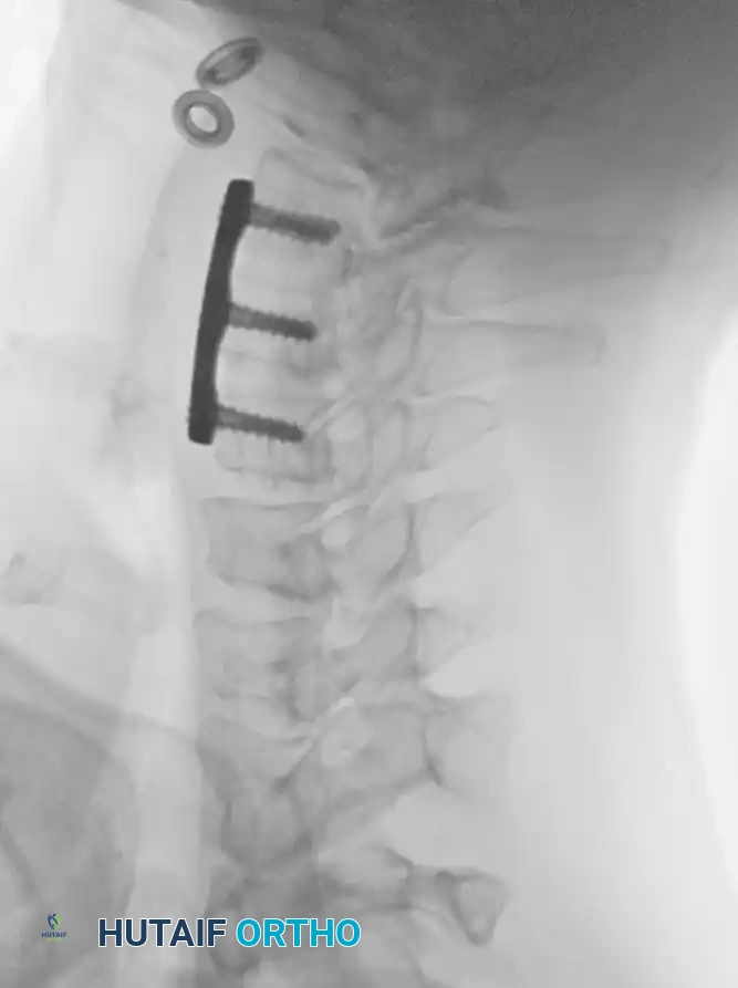 Anterior Plating Diagram A