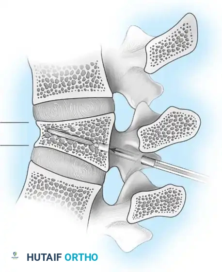 Preoperative Radiograph Example 4