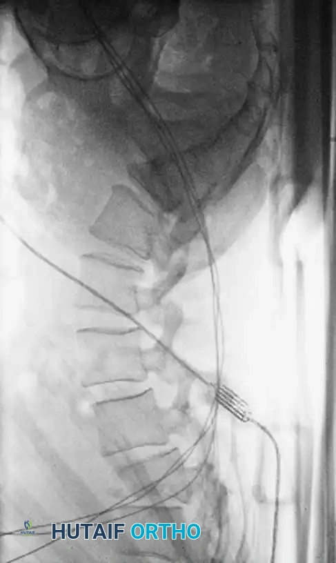 Intraoperative Fluoroscopy 4