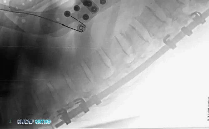 Intraoperative Fluoroscopy 6