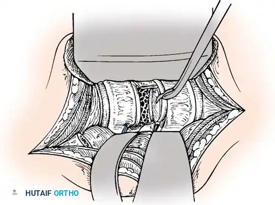 Pedicle Screw Diagram 6