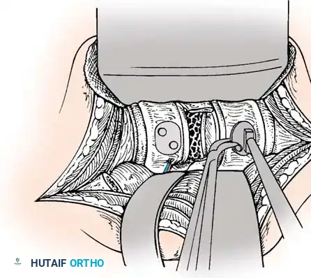Pedicle Screw Diagram 1