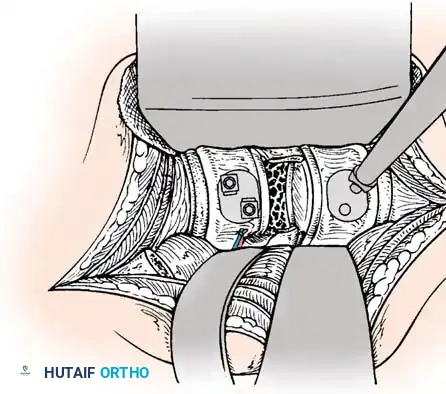 Pedicle Screw Diagram 3