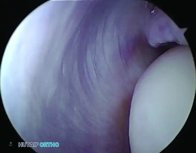 THROWING INJURIES Surgical Diagram
