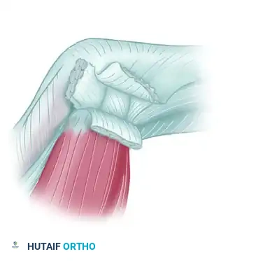 خطوات جراحية متقدمة لإصلاح تمزق الرباط الجانبي الزندي للإبهام