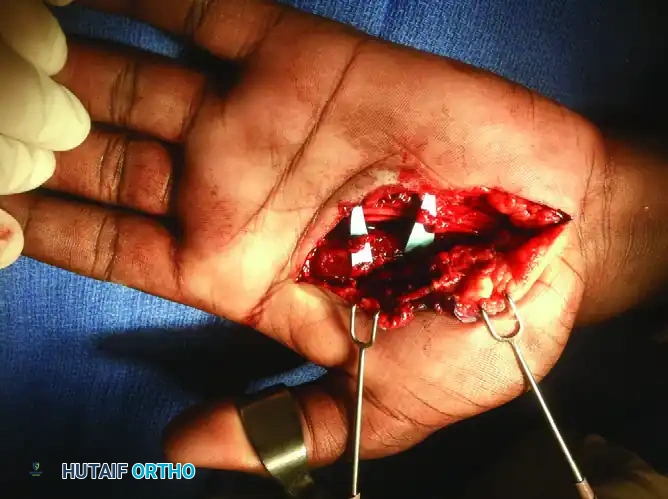 Operative Management of Bennett Fractures and Thumb CMC Joint Trauma
