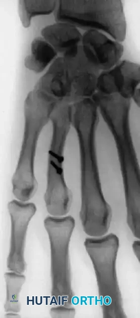صورة شعاعية توضح التقييم الدقيق لمفصل قاعدة الإبهام والكسر المحتمل