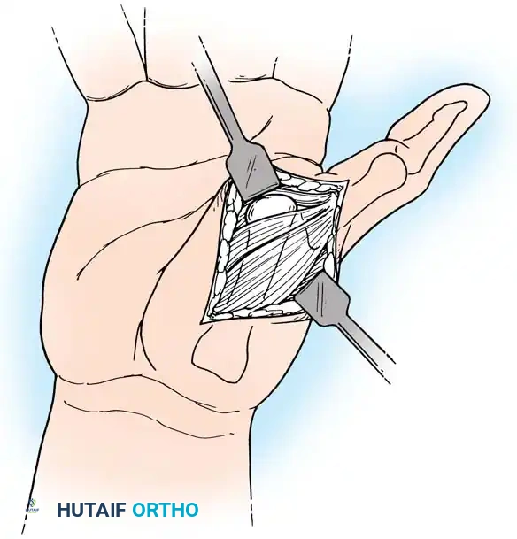 استخدام الميكروسكوب الجراحي لضمان دقة العمل
