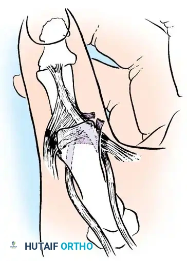 إغلاق الجرح بخيوط تجميلية دقيقة