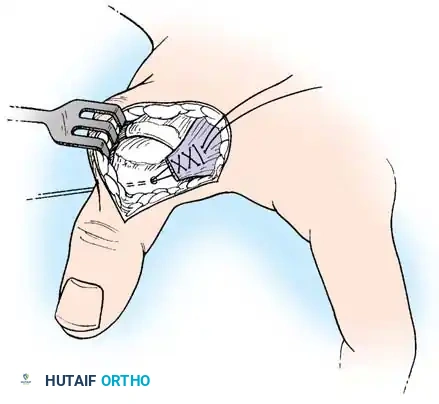 متابعة الجروح لتجنب أي عدوى محتملة