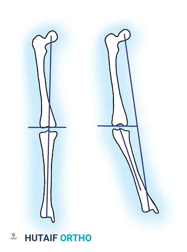 TIBIA VARA (BLOUNT DISEASE) Surgical Diagram