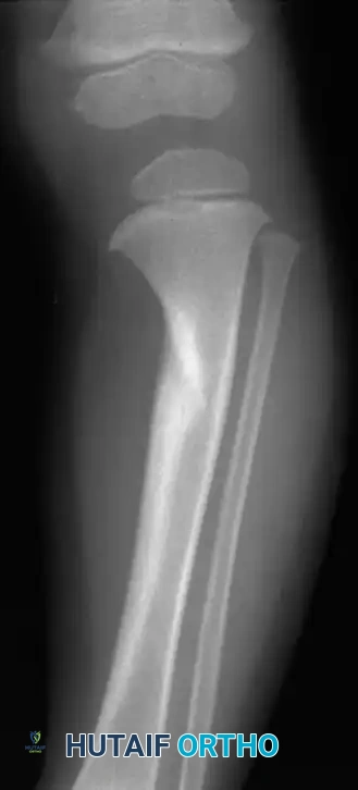 Fig. 29-44 Fibrocartilaginous dysplasia in proximal tibia with resultant varus deformity simulating “bowlegs” of Blount disease.