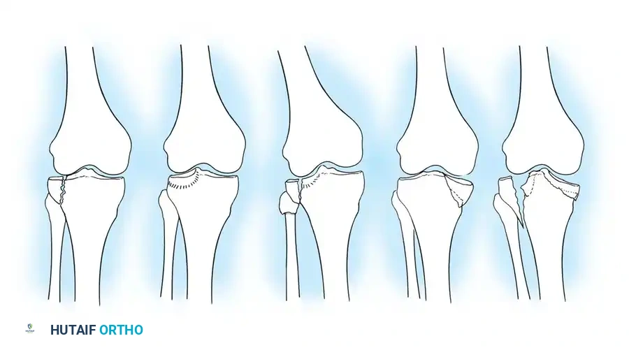 تصنيف هول ومور لكسور هضبة التيبيا
