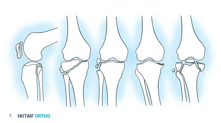 أنواع كسور وخلع هضبة التيبيا