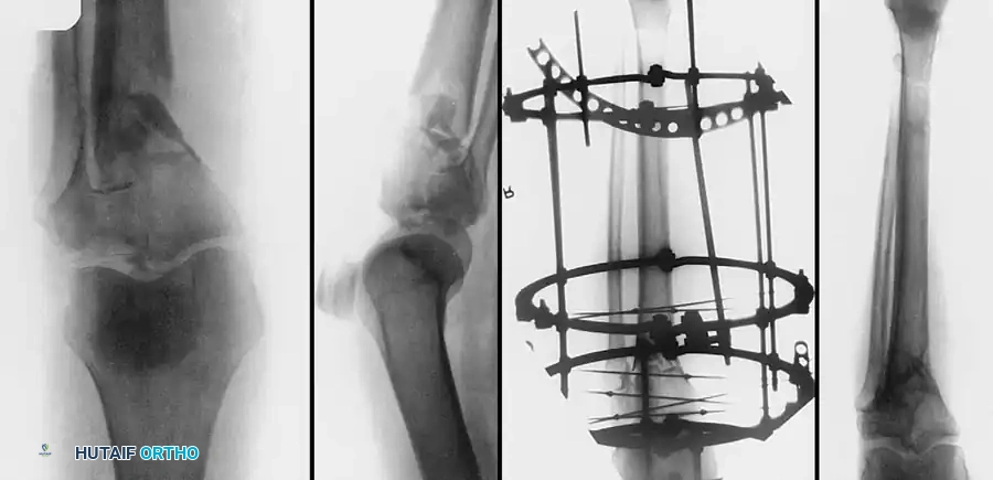 تثبيت الكسر باستخدام الشرائح والمسامير