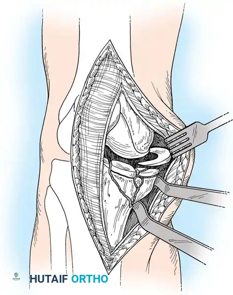 متابعة التئام الكسر بالأشعة بعد الجراحة