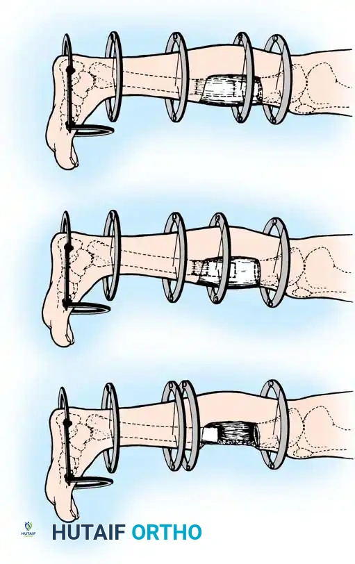 Comprehensive Management of Tibial Shaft Fractures: Operative Techniques and Evidence-Based Protocols