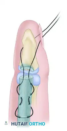 Fig. 66-29 ). If several tendon ends are to be fixed to bone, they are best inserted into a large hole drilled in the bone.