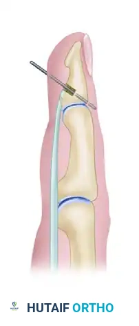 TIMING OF FLEXOR TENDON REPAIR Surgical Diagram