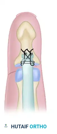 TIMING OF FLEXOR TENDON REPAIR Surgical Diagram