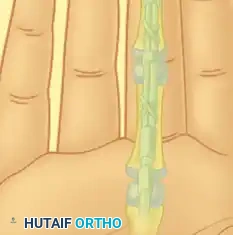 Zone I Distal to sublimis