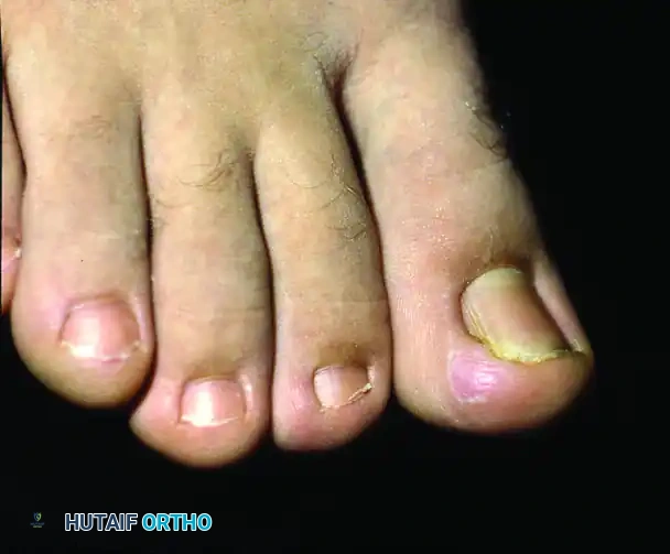 TOTAL NAIL PLATE REMOVAL Surgical Diagram