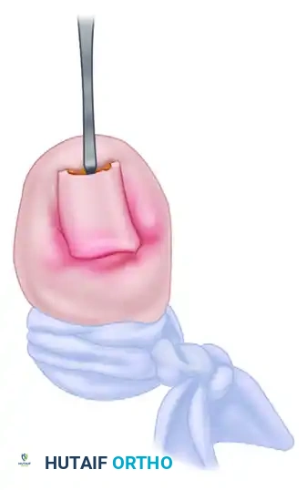 FIGURE 87-6 A and B, Turned up pulp deformity after multi ple nail avulsions for treatment of ingrown toenail. C, Turned up deformity after several nail avulsions. SEE TECHNIQUE 87-1 .