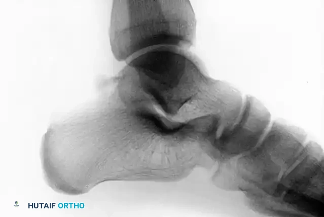 TRANSCHONDRAL FRACTURES OF THE TALUS Surgical Diagram