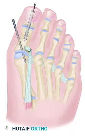 TRANSFER OF EXTENSOR HALLUCIS LONGUS WITH ARTHRODESIS OF THE INTERPHALANGEAL JOINT OF THE HALLUX Surgical Diagram