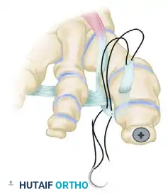 TRANSFER OF EXTENSOR HALLUCIS LONGUS WITH ARTHRODESIS OF THE INTERPHALANGEAL JOINT OF THE HALLUX Surgical Diagram