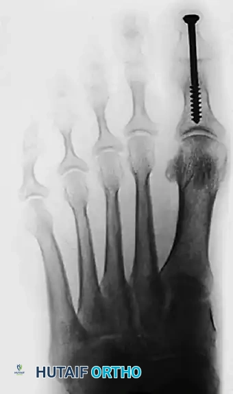TRANSFER OF EXTENSOR HALLUCIS LONGUS WITH ARTHRODESIS OF THE INTERPHALANGEAL JOINT OF THE HALLUX Surgical Diagram