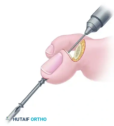 TRANSFER OF EXTENSOR HALLUCIS LONGUS WITH ARTHRODESIS OF THE INTERPHALANGEAL JOINT OF THE HALLUX Surgical Diagram