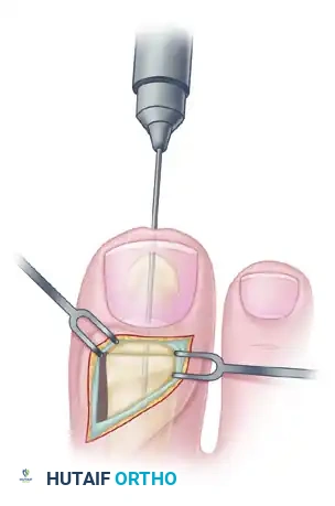 TRANSFER OF EXTENSOR HALLUCIS LONGUS WITH ARTHRODESIS OF THE INTERPHALANGEAL JOINT OF THE HALLUX Surgical Diagram