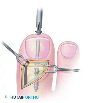 TRANSFER OF EXTENSOR HALLUCIS LONGUS WITH ARTHRODESIS OF THE INTERPHALANGEAL JOINT OF THE HALLUX Surgical Diagram