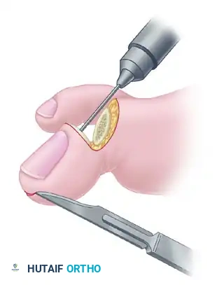 TRANSFER OF EXTENSOR HALLUCIS LONGUS WITH ARTHRODESIS OF THE INTERPHALANGEAL JOINT OF THE HALLUX Surgical Diagram