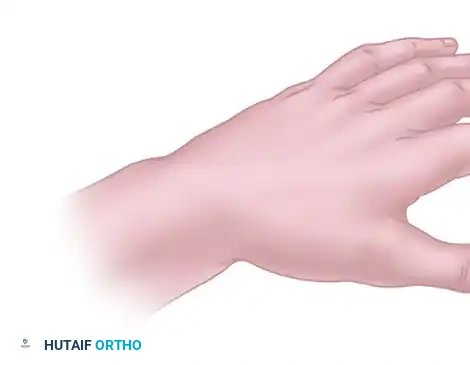 Tendon Transfer for Thumb Adduction Restoration: Boyes and Smith Techniques