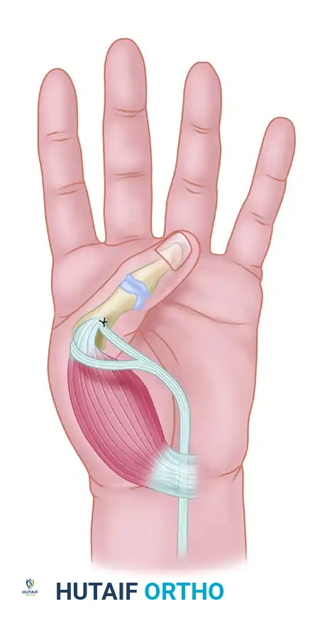 Tendon Transfers for Thumb Adduction and Index Finger Abduction