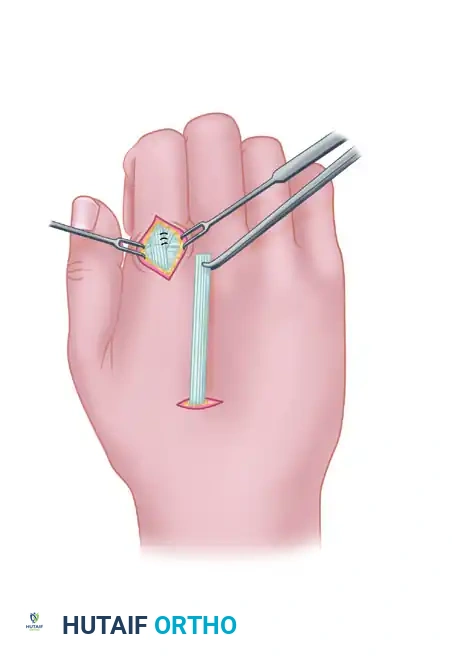 TRANSFER OF THE EXTENSOR INDICIS PROPRIUS Surgical Diagram