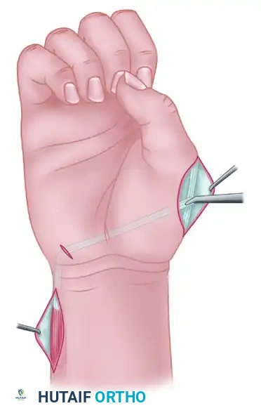 Extensor Indicis Proprius Transfer for Thumb Opposition (Opponensplasty)