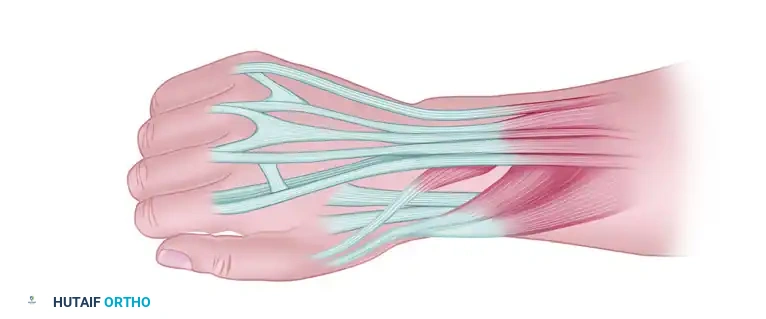 TRANSFER OF THE FLEXOR CARPI ULNARIS Surgical Diagram