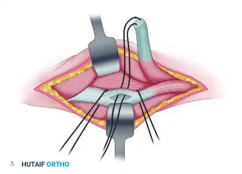 TRANSFER OF THE FLEXOR CARPI ULNARIS Surgical Diagram